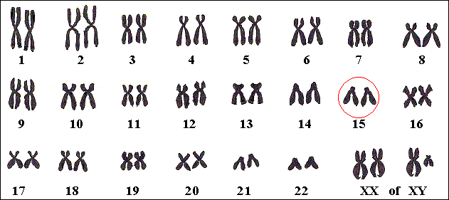 Chromosomenkaart van een persoon met Angelman.