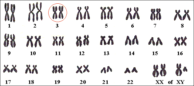 Het enige gekende Brugada-gen ligt op chromosoom nummer 3.