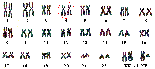 Bij Wolf-Hirschhorn ontbrekt een stukje van één van beide chromosomen nr 4.