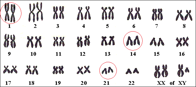 Genen voor Alzheimer liggen op de chromosomen 1, 14 of 21.