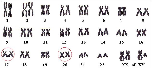 Soms zijn genen op de chromosomen 17 of 20 de oorzaak.