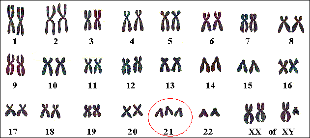 Chromosomenkaart van een persoon met Downsyndroom, met drie keer chromosoom nr. 21.