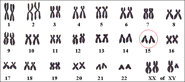 Sommige gevallen van Dyslexie worden gelinkt aan een gen op chromosoom 15.