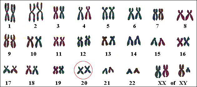 Een PKAN-patiënt heeft een gen voor de ziekte op beide chromosomen nr 20; een drager heeft dat gen op slechts één chromosoom.