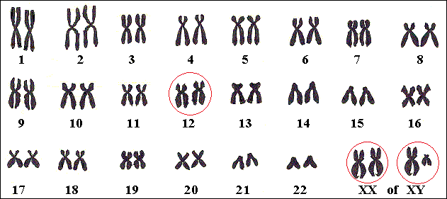 Genen die Kabuki veroorzaken, zijn bekend op chromosoom 12 en het X-chromosoom.