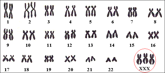 Chromosomenkaart van een meisje met Triple X, met drie X-chromosomen.